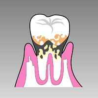 歯を支える骨が溶け、歯が抜け落ちる