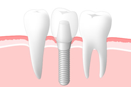 インプラント料金